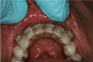 Application of Dentapreg® SFM strip for discreet and secure post-orthodontic retention.