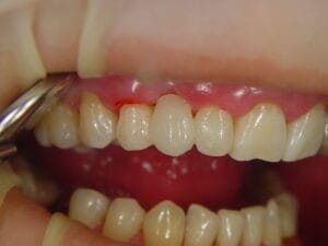 Tooth secured with Dentapreg® PFM strip on isolated adjacent teeth.