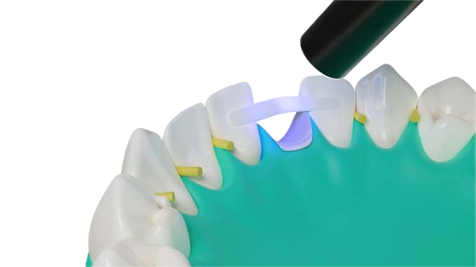 Proceso de polimerización de la tira Dentapreg® PFM con luz UV sobre un modelo dental para su estabilidad.