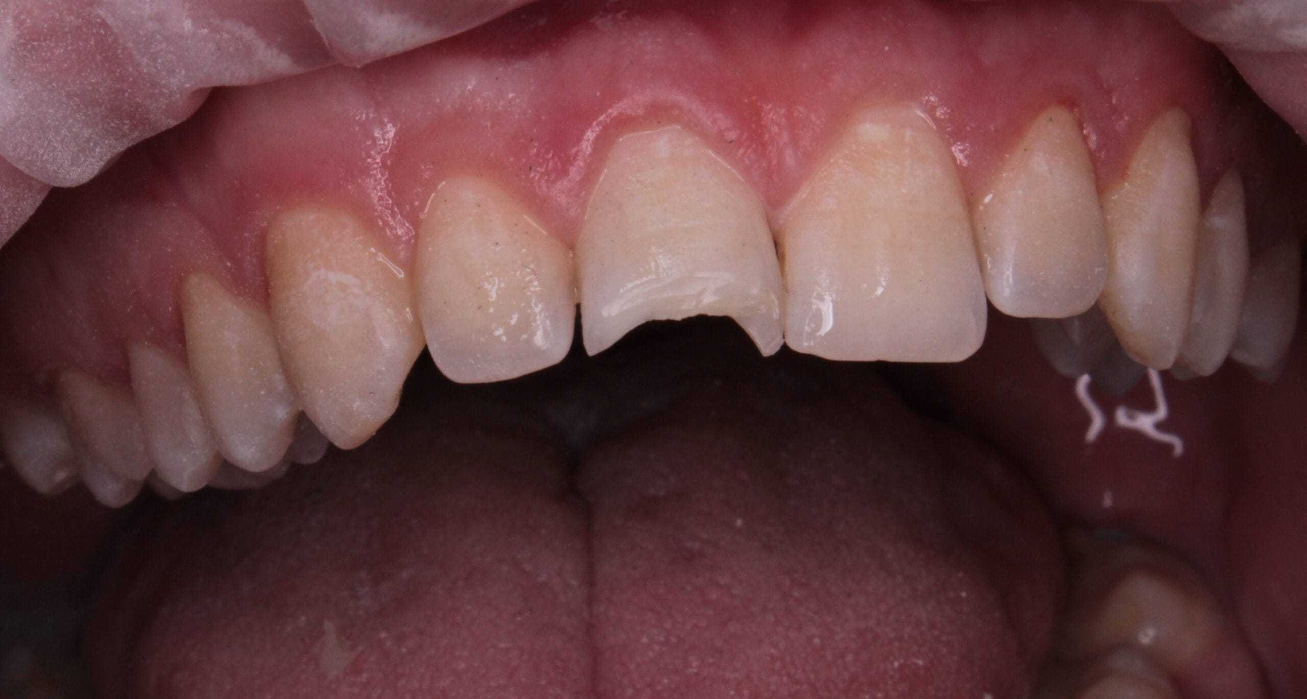 Fractured incisor before Dentapreg® UFM restoration.