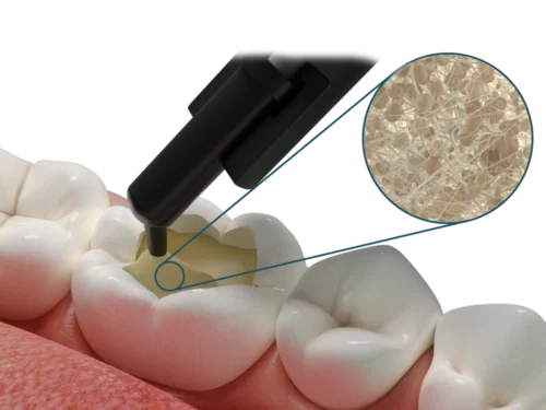 Fibrafill® DENTIN Short fiber Bulk Fill