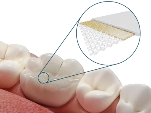Dentapreg® UFM Restorations Reinforcement
