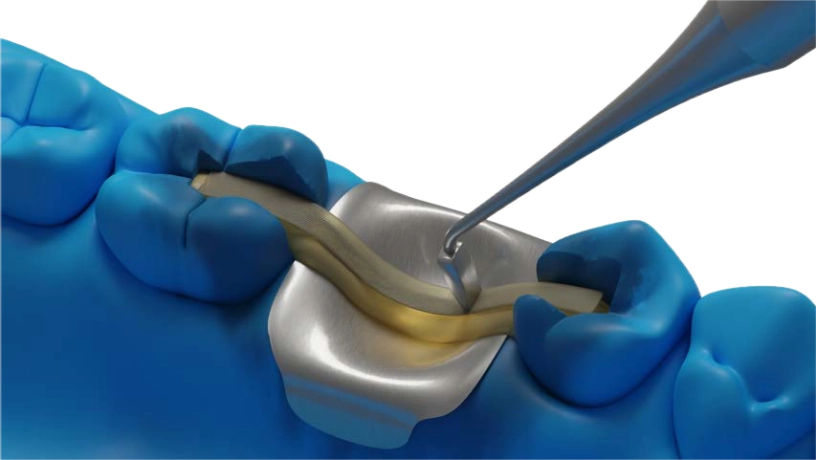 vertical_1-e960cce8 Aplicación de la tira Dentapreg PFU® en un procedimiento dental con estratificación de composite.