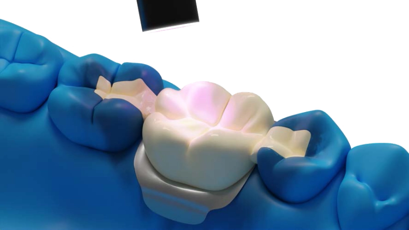 vertical_2-2f04ced4 Fotopolimerización del material compuesto sobre la tira Dentapreg PFU® para la restauración dental duradera.